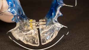 ortodoncja bronowice- gabinet ortodontyczny Kraków-aparaty ortodontyczne-ortidnta-katarzyna-strusiewicz-bieniek (23)